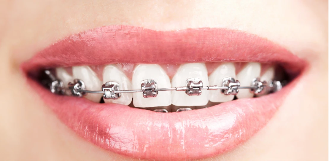 multi-bague au cabinet MICHELET ORTHODONTIE