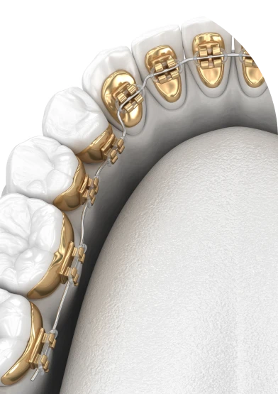 lingual win au cabinet MICHELET ORTHODONTIE